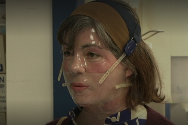 Bálköstur sprakk í andlit móður